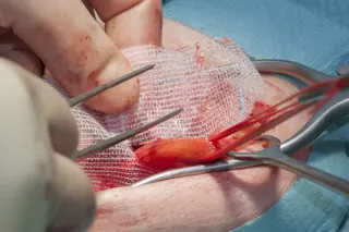 Fresh hernia mesh in surgery